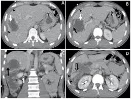 Liver Hydatid Cyst Treatment in Electronic City
